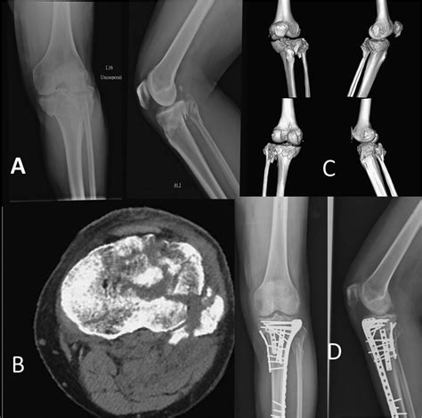 One Case Of Three Column Tibial Plateau Fracture With Pl Corner Injury