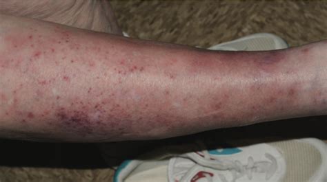 Year Old Female With Rash On Lower Extremities The Doctor S Channel