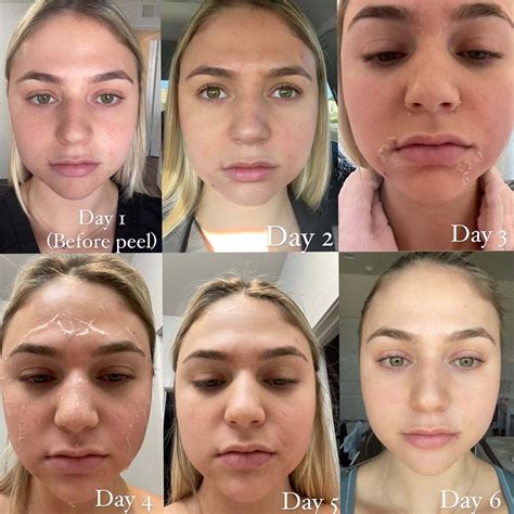 Day By Day Chemical Peel Recovery The Ultimate Guide
