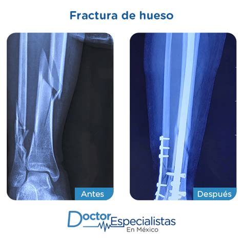 Mejores Ortopedistas En Fractura De Hueso Doctor Especialistas