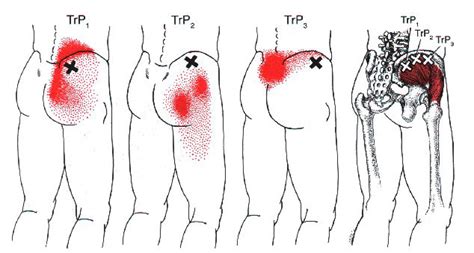 Learn vocabulary, terms and more with flashcards, games and other study tools. Gluteus Medius | The Trigger Point & Referred Pain Guide