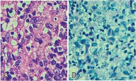 Primary Cutaneous Histoplasmosis Difficult To Treat In Immunocompetent