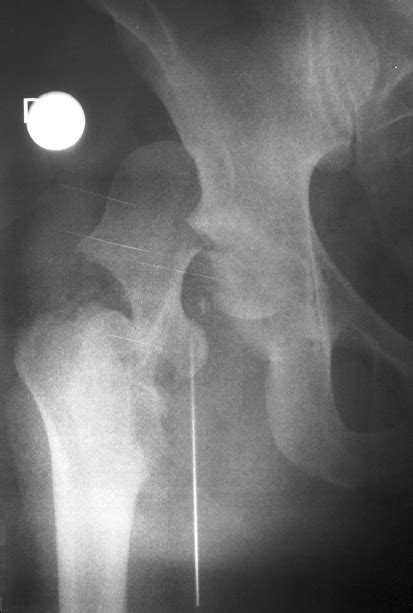 Initial Right Hip X Ray Showing A Posterior Fracture Dislocation Of The