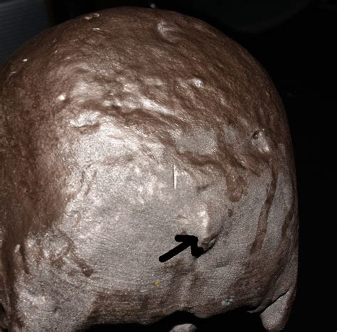 Occipital Knob Of Skull Dr Barry Eppley Indianapolis Explore Plastic