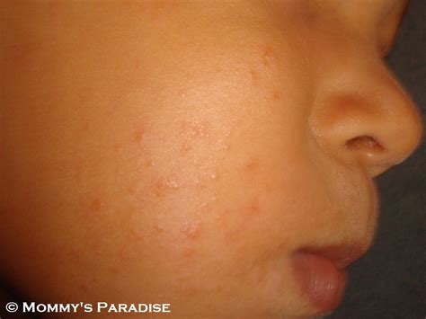Timans Face Eczema After 1 Week Oral Antibiotics Dorothee Padraig