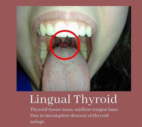 Lingual Thyroid Medizzy