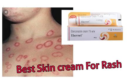 Ebernet Skin Cream Best Cream For Ring Worm Rash Skin Infection