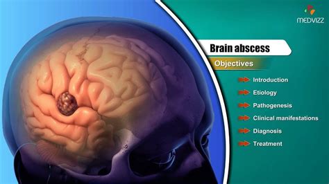 Brain Abscess Etiology Pathogenesis Clinical Manifestations