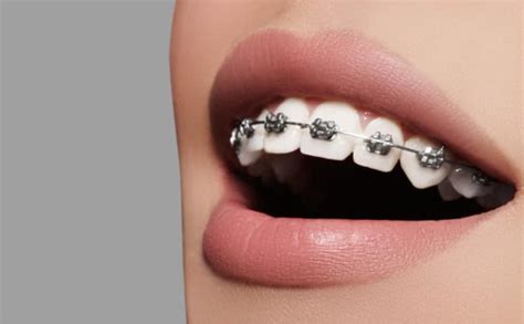 Dental Braces And Aligners Types Care What To Expect