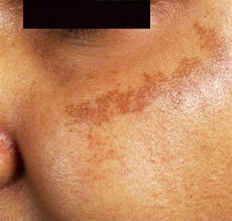 Brown Spots Appearing On Skin Pictures Photos