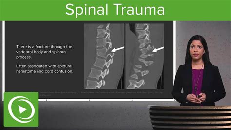 Spinal Trauma Cervical Trauma Protocol Common Spinal Fractures