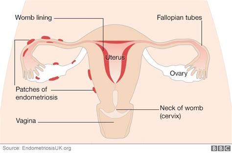 Endometriosis Treatment Unacceptable And Women Arent Diagnosed