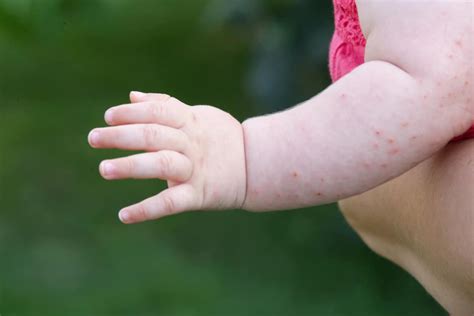 Penyebab Dan Cara Mengatasi Bintik Merah Pada Kulit Bayi Honestdocs