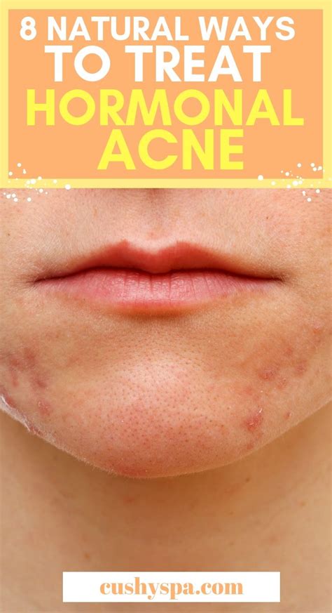 How To Treat Hormonal Acne Naturally 8 Treatments Natural Acne Treatment Acne Treatment