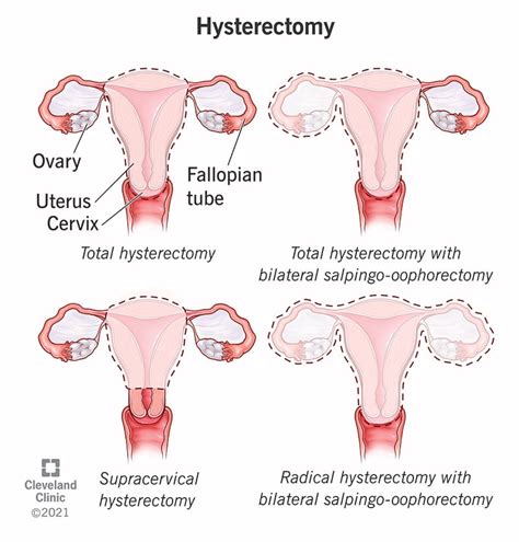 Benefits Of Hysterectomy For Fibroids