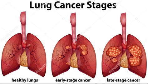 Cancer Lung Lining Gambaran