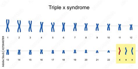 Triple X Syndrome Karyotype Vector ESP Stock Vector Adobe Stock