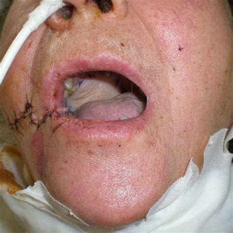 Squamous Cell Carcinoma Of The Right Cheek And Tonsillar Pillar