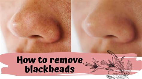 Diy Blackhead Remover How To Remove Blackheads At Home Youtube
