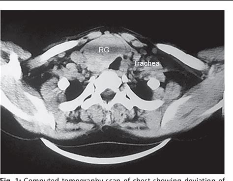 Figure 1 From Management Of Retrosternal Goiter Without Sternotomy A