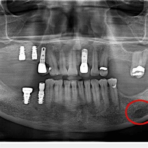 Panoramic Radiograph Showing Well Defined Radiolucency Bilaterally In