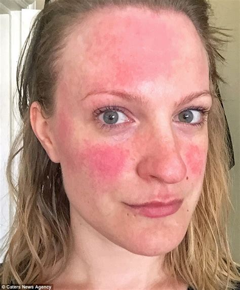 London Woman Suffering From Rosacea Skin Condition Ditches Gluten For A