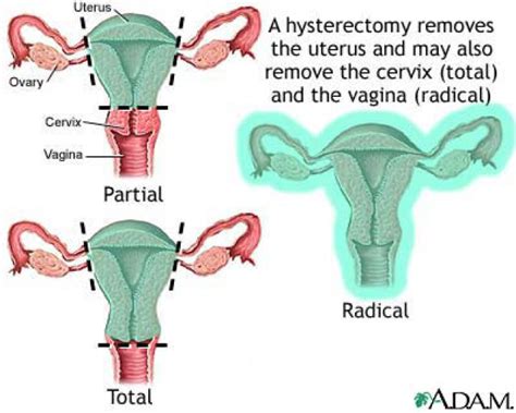 【hysterectomy】什么意思英语hysterectomy的翻译音标读音用法例句在线翻译有道词典