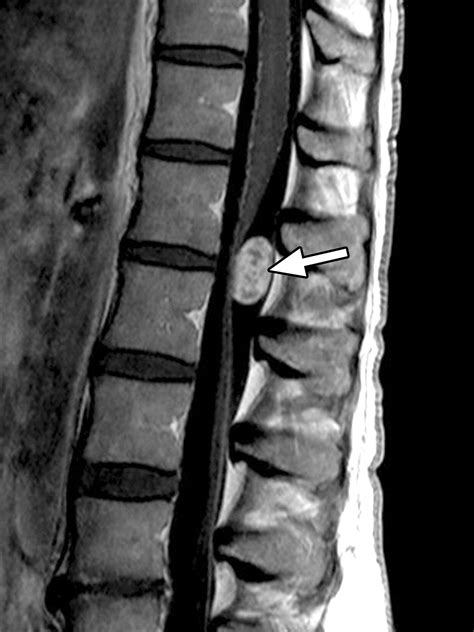 Lumbar Spine Mri Demonstrating Intradural Extramedullary Spinal Sexiezpix Web Porn