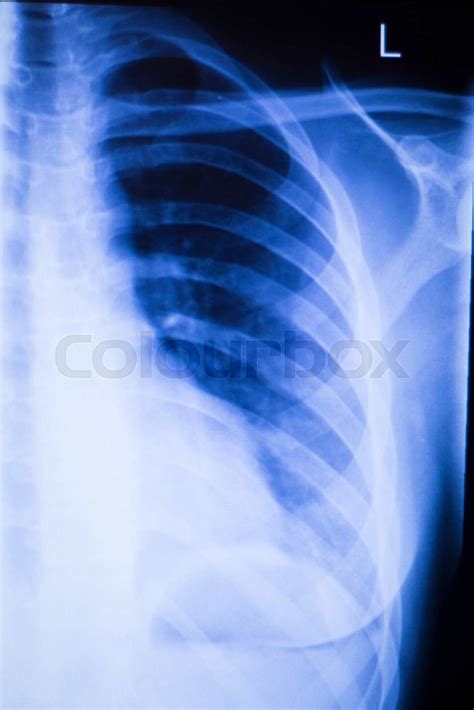 Shoulder Joint Orthopedic Xray Scan Stock Image Colourbox
