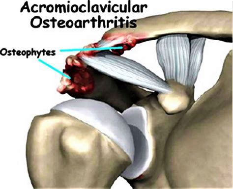 Acromioclavicular Joint Acromioclavicular Joint Injury Separation Osteoarthritis