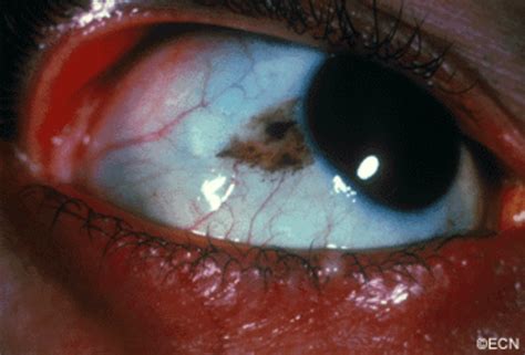 Pigmented Conjunctival Cancers Primary Acquired Melanosis New York