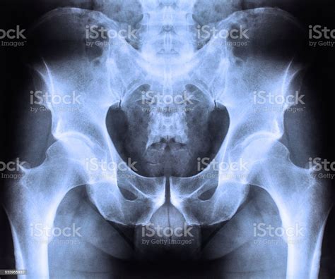 X Ray Of Spine And Pelvis Stock Photo Download Image Now 2015