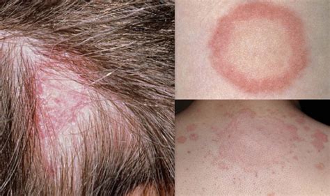 Ringworm Symptoms A Ring Shaped Rash On Your Skin Could Indicate The