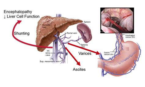 Learn vocabulary, terms and more with flashcards, games and other study tools. Portal Hypertension and Why it's Important in Liver Disease