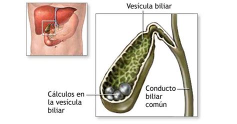 Piedras En La Vesicula Biliar Causas Y Tratamiento Aprendafaciles Images