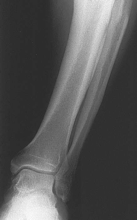 Tibial Malunion And Medial Knee Oa