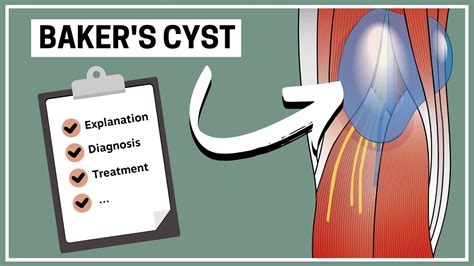 What Is A Bakers Cyst Explanation Diagnosis And Treatment Youtube