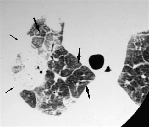 Acute Eosinophilic Pneumonia Thin Section Ct Findings In 29 Patients