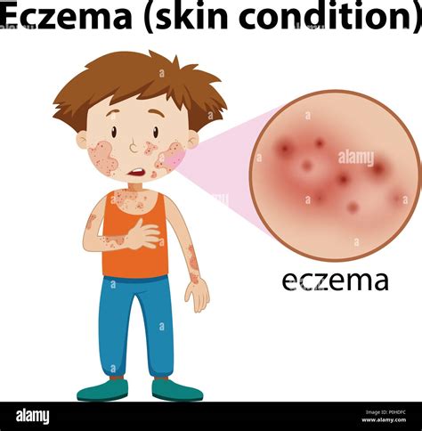 Magnified Eczema On Young Boy Illustration Stock Vector Image And Art Alamy