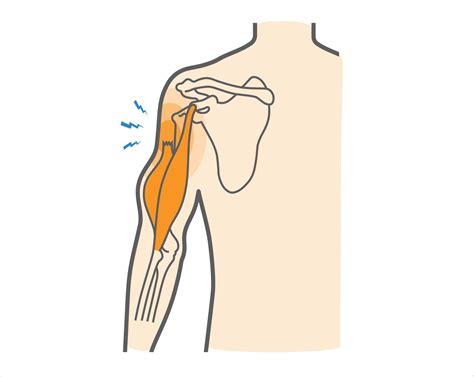 What Is Proximal Biceps Rupture How To Treat This Condition Upswing Health