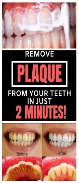 Naturally Whiten Teeth 10 Ways To Remove Tartar Stains From Your Teeth
