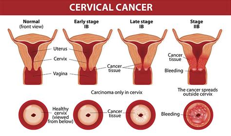 Why Women In Their S And S Are More Prone To Cervical Cancer Kelsey Seybold Clinic