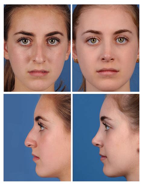 Bestof You Top Bulbous Nose Rhinoplasty Before And After In 2023 Check