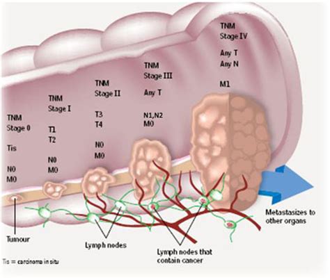 What Is Stage 4 Colon Cancer Continuing Medical Education For Calvin