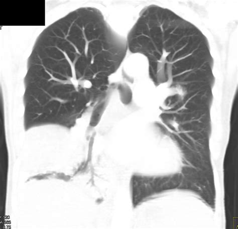 Hepatization Of Right Lower Lung Chest Case Studies Ctisus Ct Scanning
