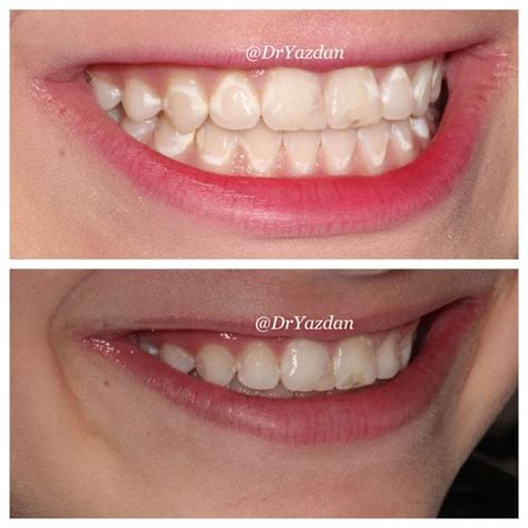 Treatment For Stubborn White Spots On Teeth Center For Restorative