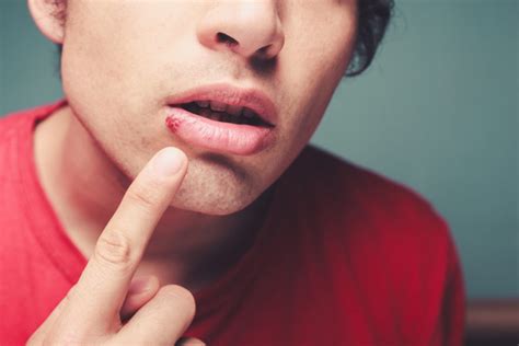 4 Types Of Mouth Sores And How Theyre Treated Hoffman Dental Care