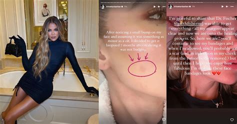 Khloe Kardashian Opens Up About Skin Cancer Scare Undergoes Operation To Remove Tumor From Her