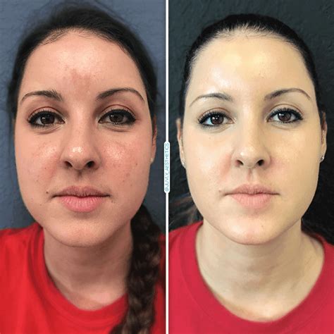 ipl photo facial before and after great porn site without registration