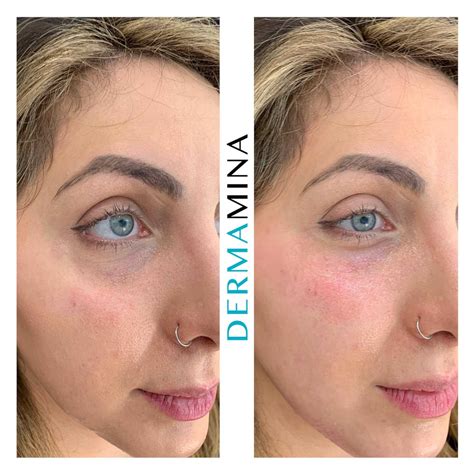 What Is The Cheek Filler Treatment And How Does It Work · Dermamina